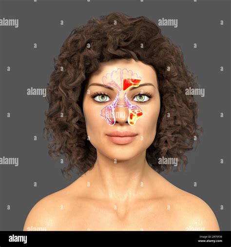 Sinus infection, or sinusitis, computer illustration. The sinuses are