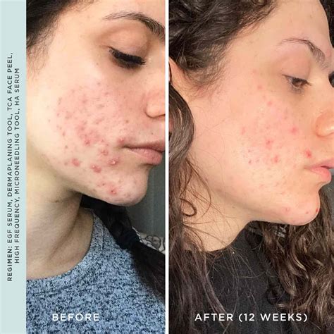 high frequency wands for face 9