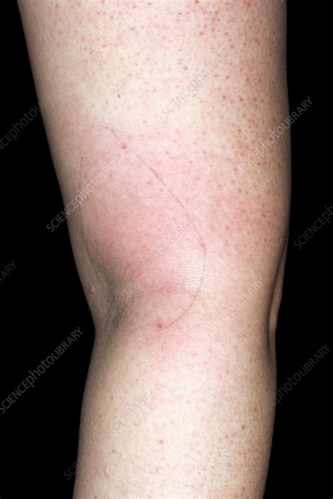Phlebitis - Stock Image - C058/1265 - Science Photo Library
