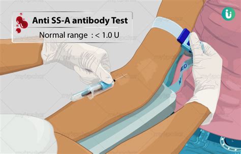 Anti SS-A antibody Test: Procedure, Purpose, Results, Normal range ...