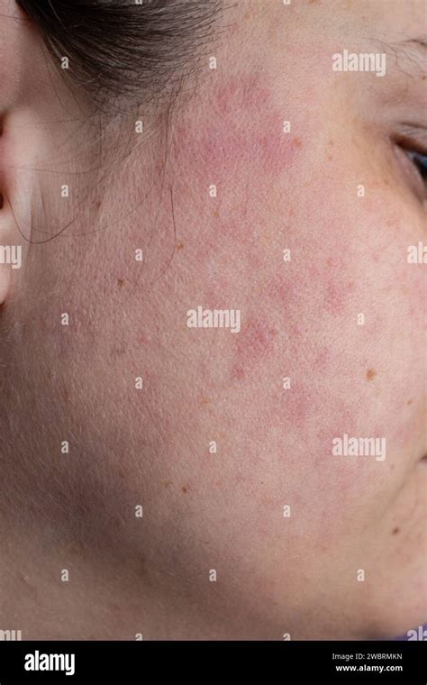 eczema red rash  face  jean richards blog