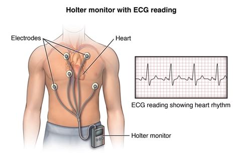 Holter Monitor - Dysautonomia-MVP Center - Paula Moore M.D.