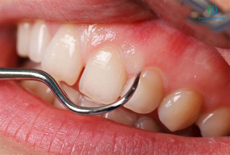 tong quan ve viem nuou rang va cach dieu tri nhanh chong