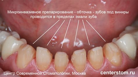 Как и когда ставится коронка на живой зуб, а когда - без нерва | Центр ...