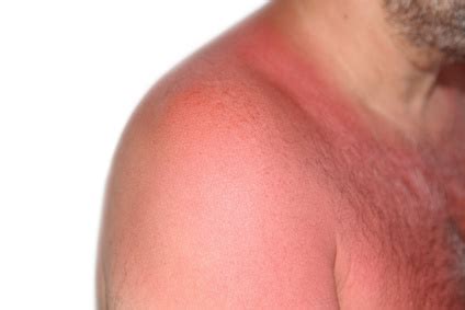 Érythème : symptômes, traitement, définition - docteurclic.com