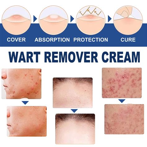 New Anti-wart Cream Hand Foot And Face Flesh Granules Filamentous