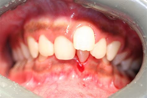 Case 22: Overlapping incisors | Teeth N Braces