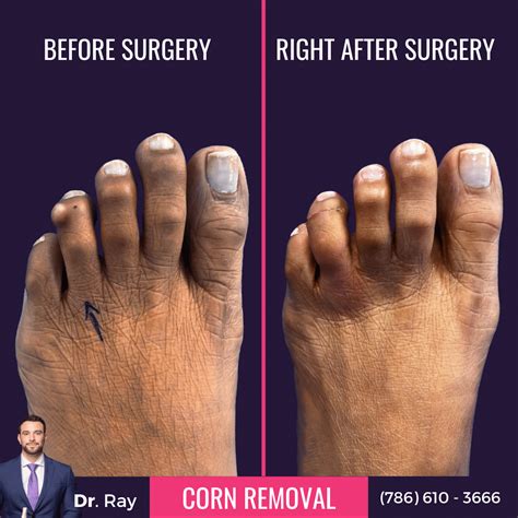 What to Know About Corn Removal Surgery Before And After