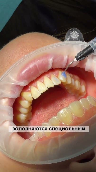 элайнеры Invisalign - YouTube