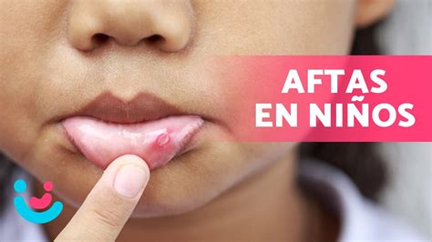 Guía completa: Cómo curar las llagas en la boca de los niños de forma ...