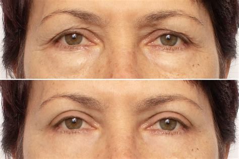 Why Does My Upper Eyelid Feel Heavy? | Dr. Kopelman