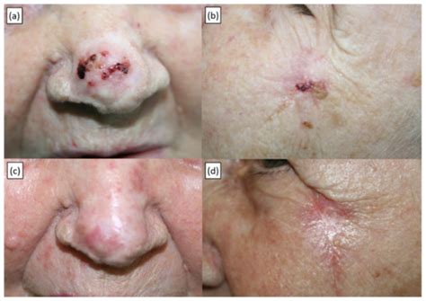 Current Oncology | Free Full-Text | Treatment of Basal Cell Carcinoma ...