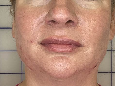 smile line filler before and after 6