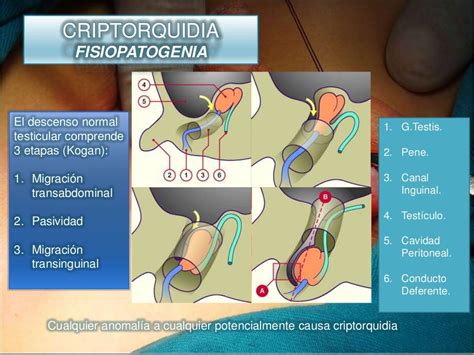 criptorquidia