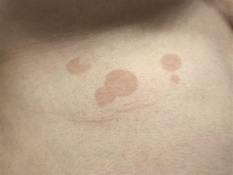 Red Spots On Side Of Breast at Henry Horning blog
