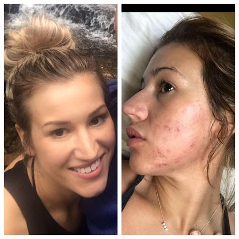 [acne] Fungal acne (malassezia) has destroyed my skin. May -> November