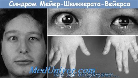 Синдром Мейер-Швиккерата-Вейерса (Meyer-Schwickerath-Weyers) - синонимы ...