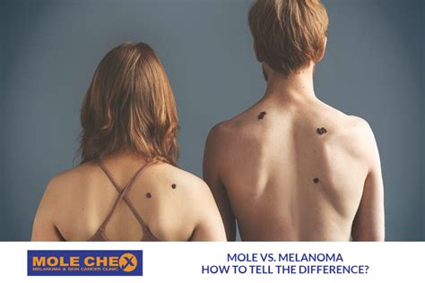 mole  melanoma     difference molechex skin cancer