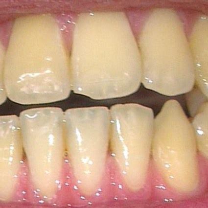 Yellow Teeth Stains: Causes + Best Treatment & Remedies