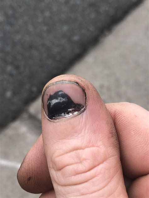 Smashed Fingernail Falling Off