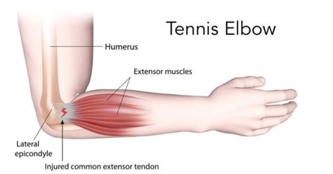 Tennis Elbow | Physiotherapy Manly