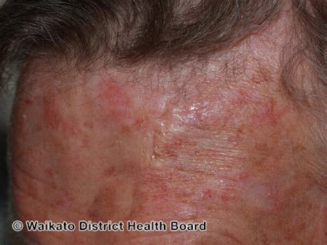 Basal Cell Carcinoma (BCC) | Skin cancer | Geeky Medics