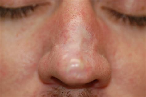 Keratoacanthoma (Squamous cell carcinoma of the keratoacanthoma type