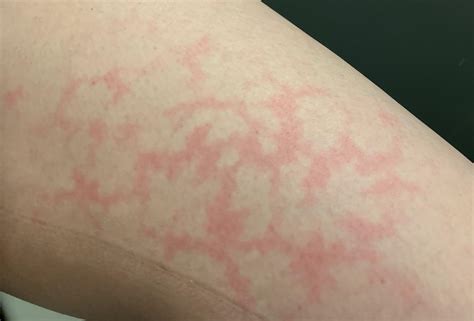 Why Is The Skin On My Thighs Burning at Fred Winfield blog