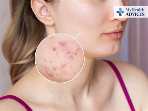 Acne: Signs, Symptoms, Causes, Prevention- myhealthadvice.com