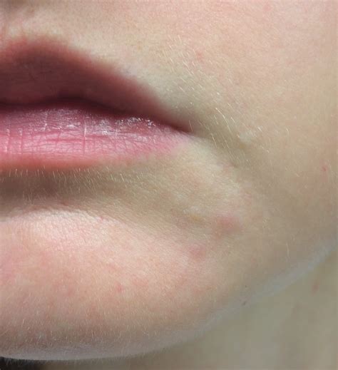 Why is perioral dermatitis often mistaken for rosacea? – what is