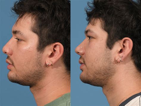 rhinoplasty