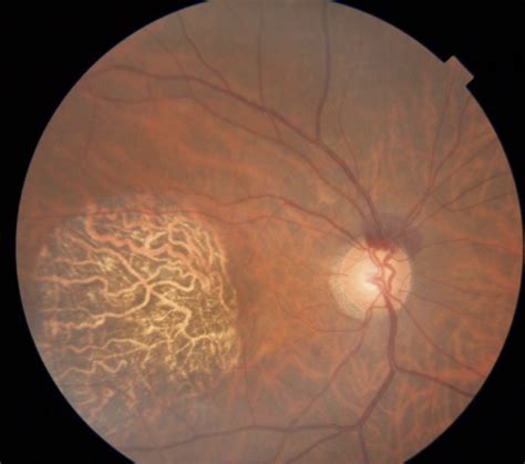 Optic Disc Hemorrhage: What Next?