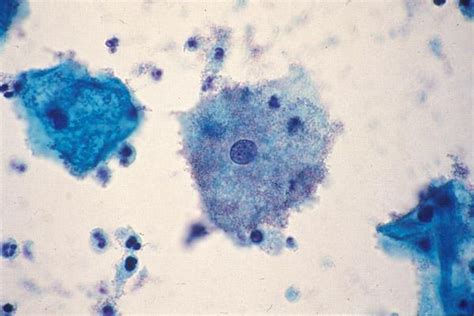Гарднерелла вагиналис (Gardnerella vaginalis): урогенитальный и ...