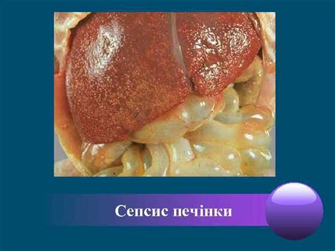 СЕПСИС КАРАНТИННІ ІНФЕКЦІЇ СИФІЛІС Сепсис Сепсис