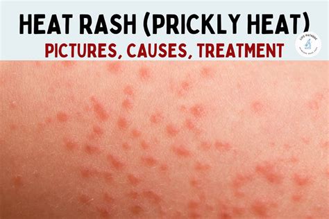 Heat Rash: Pictures, Symptoms, Causes, Types, and Treatment