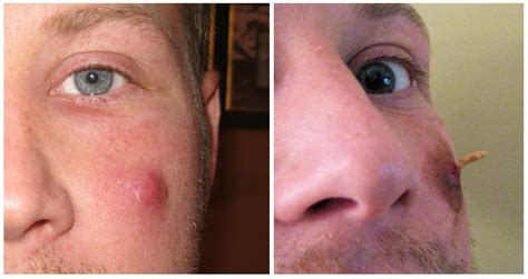 Boil on my face, before and after. Very painful! : r/popping