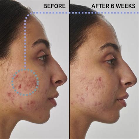 Retinol Before and After: Transform Your Skin with These Results - Must ...