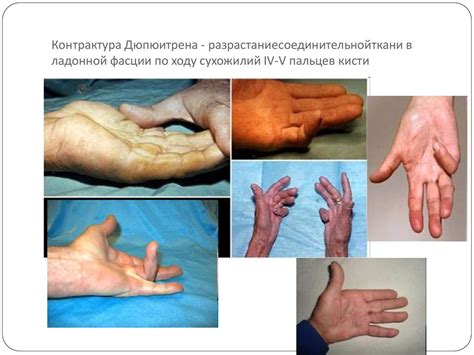 Цирроз печени - презентация онлайн