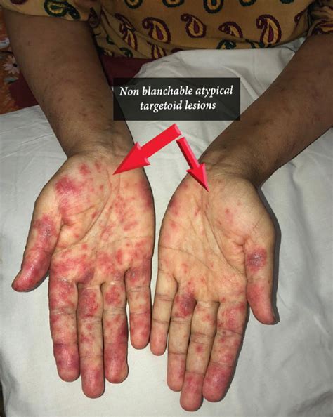 Cutaneous Lupus Face