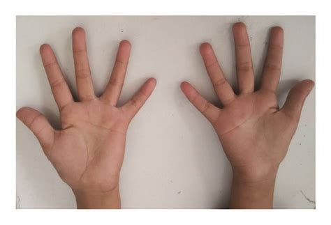 showing atrophy   thenar muscle  scientific diagram