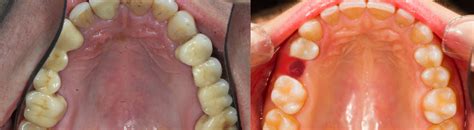 Альвеолит: лечение, профилактика, методы, симптомы - луночковые боли ...