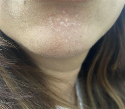I(35f) have developed these small bumps on my chin. More in comments