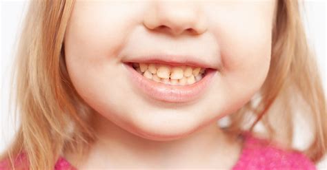 What is an overbite: types, causes and how to fix it in teeth 🦷