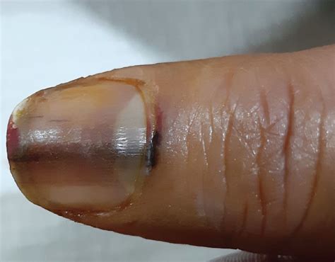 Melanoma Nail Symptoms