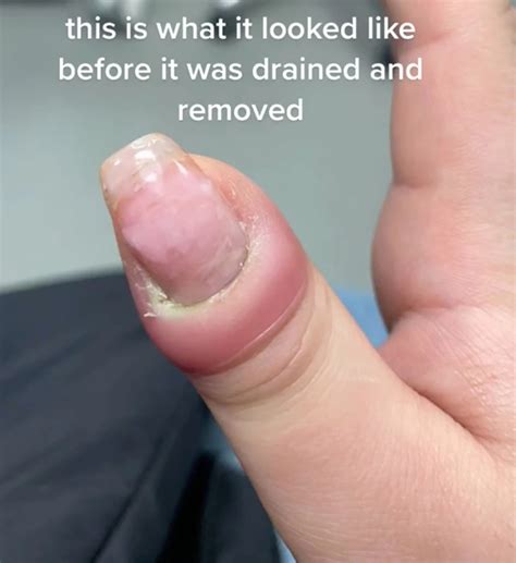 Eponychium Infection