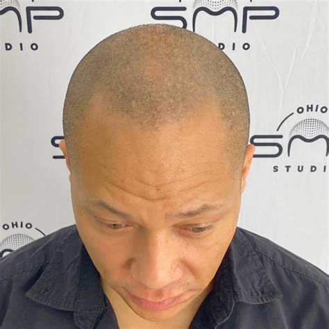 Exploring Scalp Micropigmentation Side Effects and Care | Columbus, OH