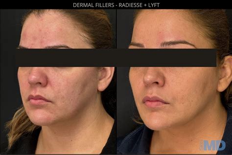 Dermal Fillers | Boston - Skin MD Laser & Cosmetic Group