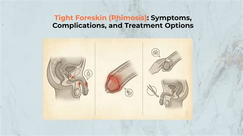Tight Foreskin (Phimosis): Symptoms, Complications, and Treatment Options