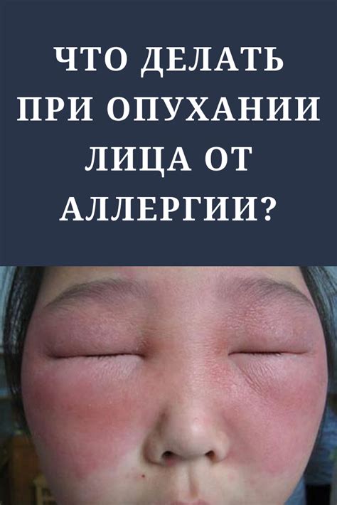 Что делать при опухании лица от аллергии? | Лицо, Косметичка, Выдержка