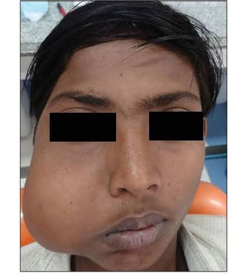 Nasopharyngeal Angiofibroma - MEDizzy